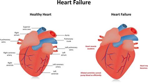 what is global lv hypokinesis